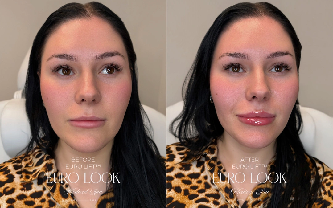 Dermal Fillers 24