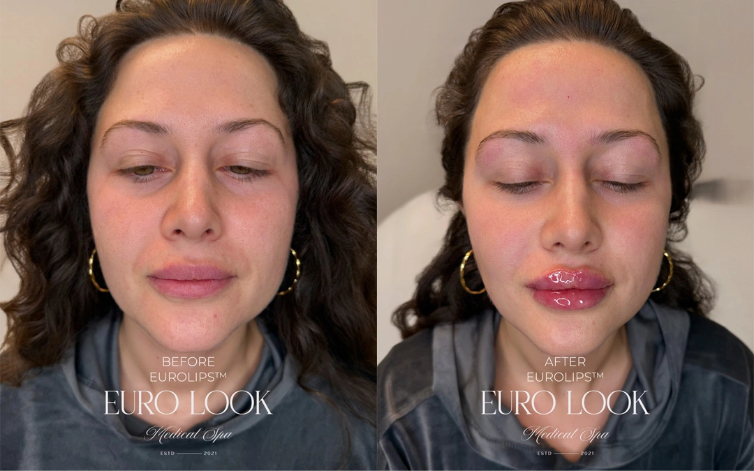 Dermal Fillers 25
