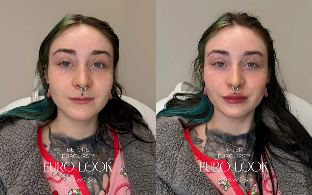 Dermal Fillers 26