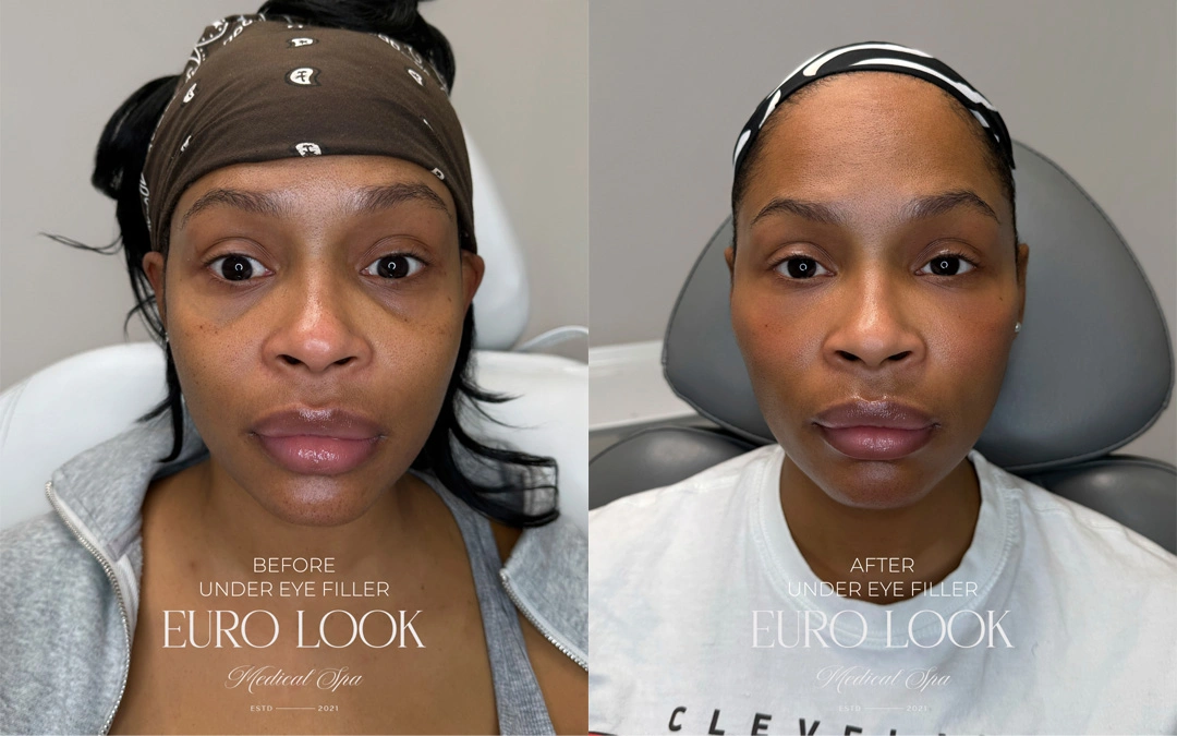 Dermal Fillers 27