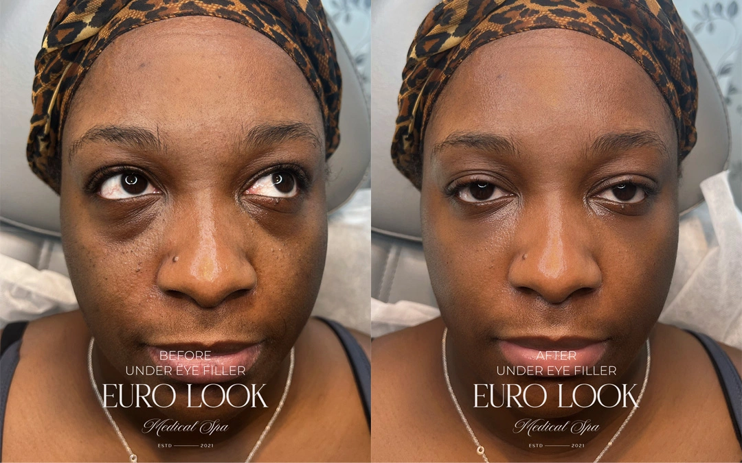 Dermal Fillers 28