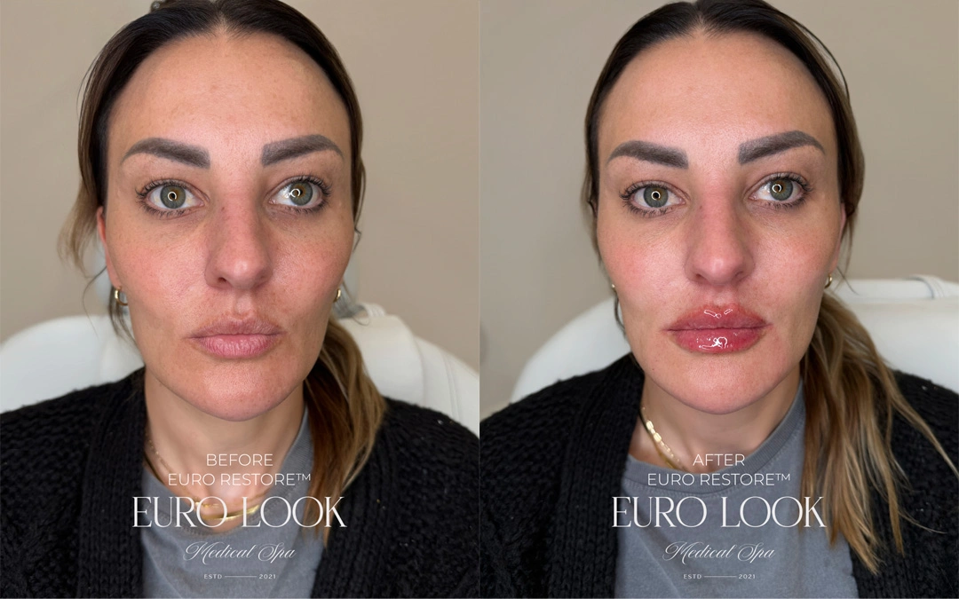 Dermal Fillers 29