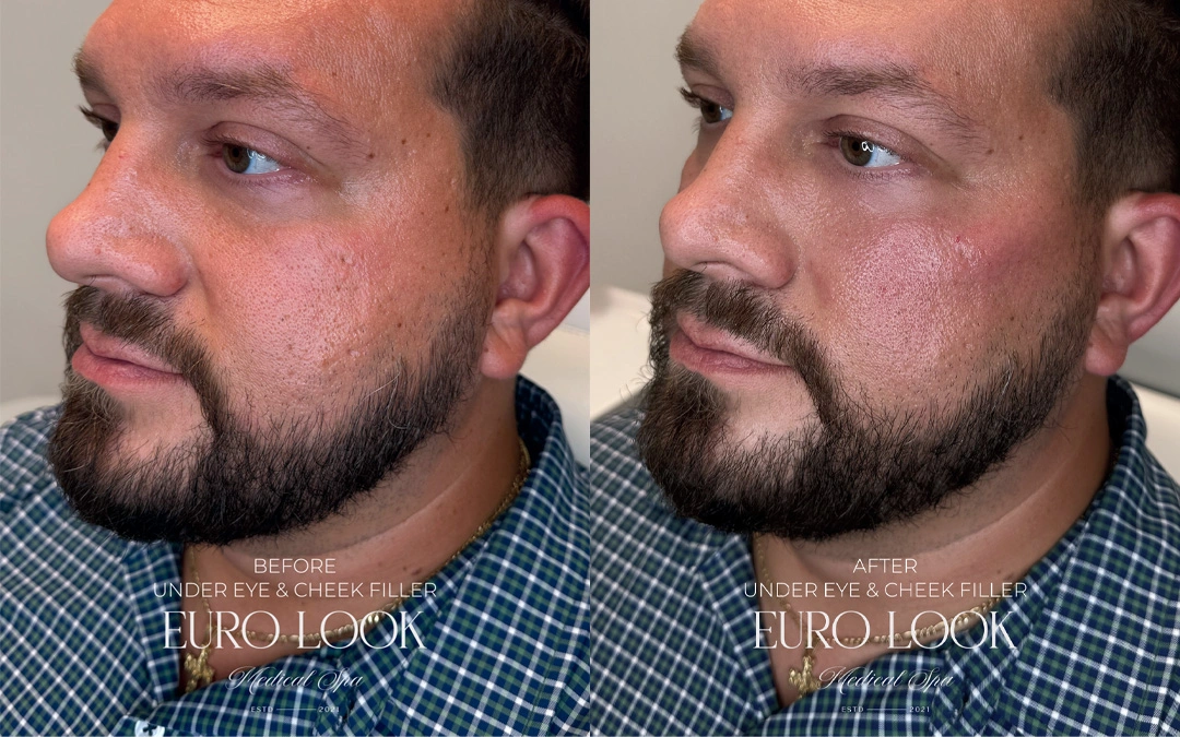 Dermal Fillers 3