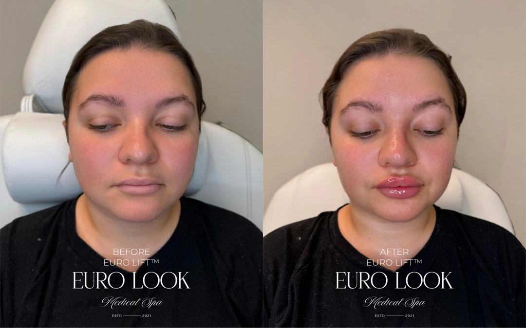 Dermal Fillers 31