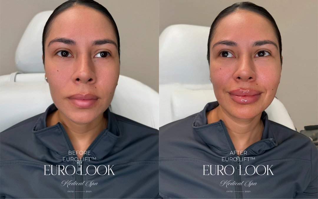 Dermal Fillers 32