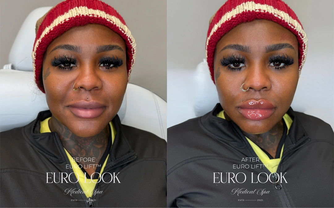 Dermal Fillers 33