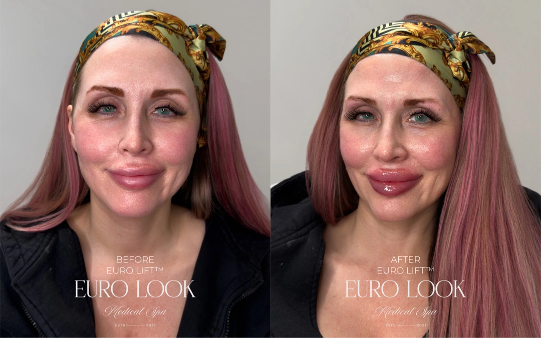 Dermal Fillers 34