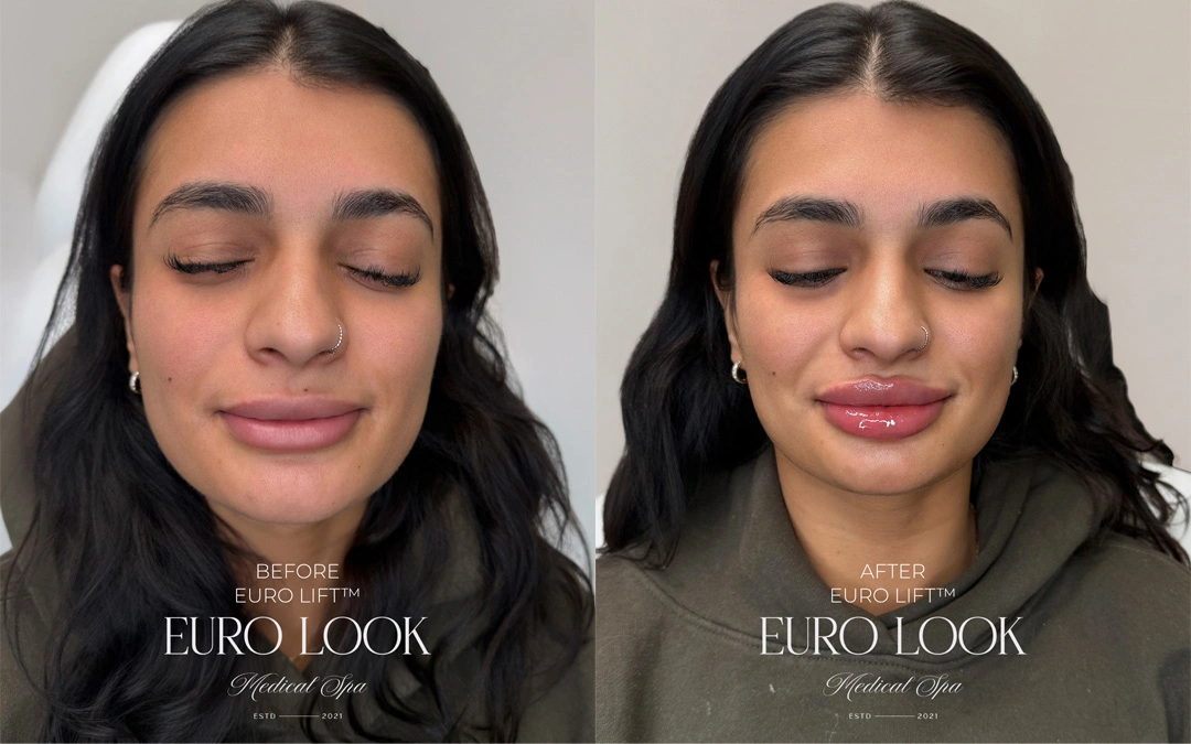 Dermal Fillers 35