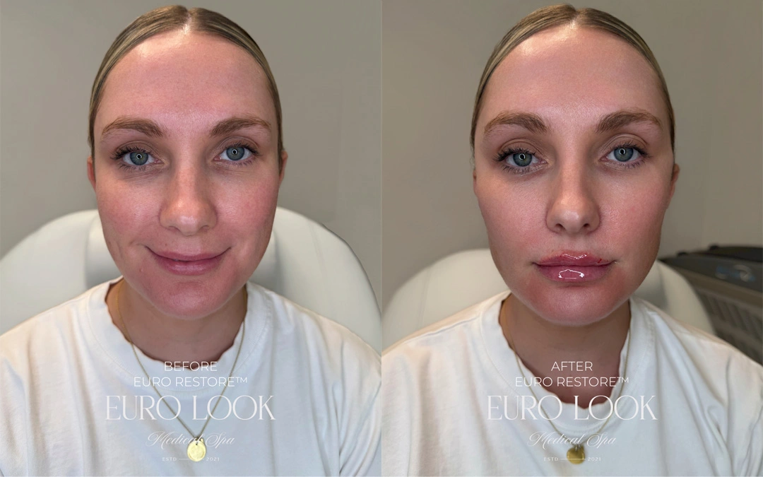 Dermal Fillers 36