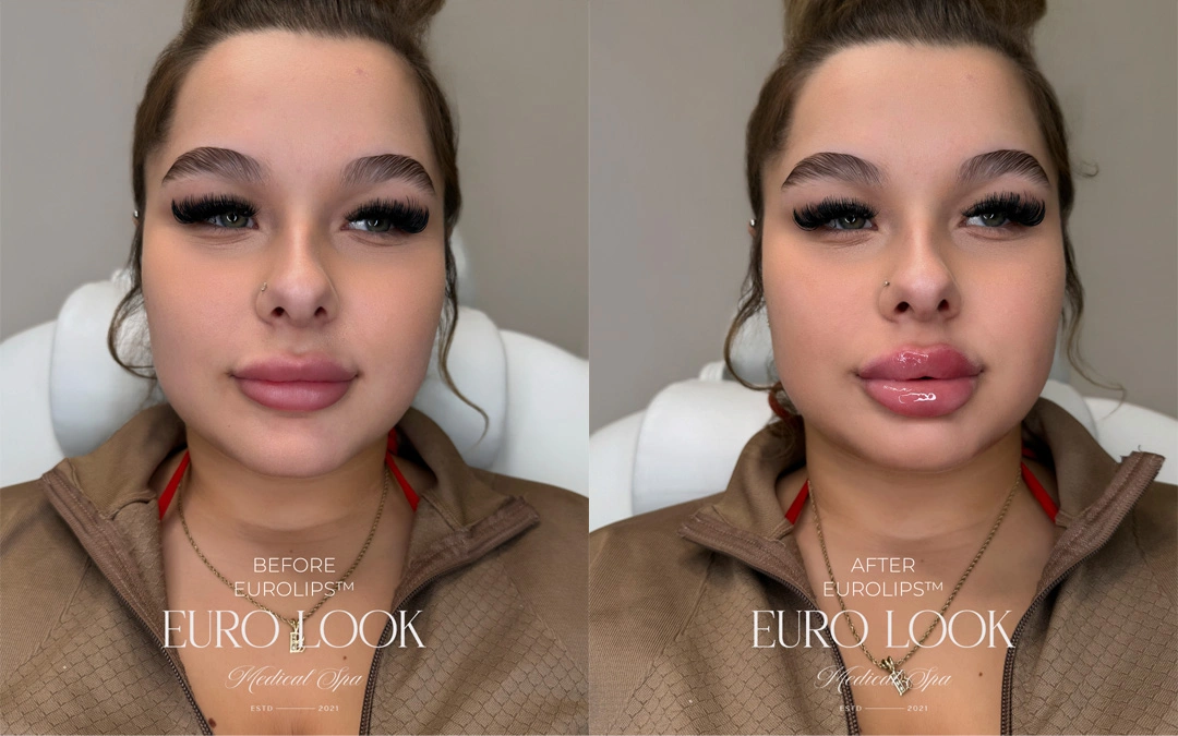 Dermal Fillers 37