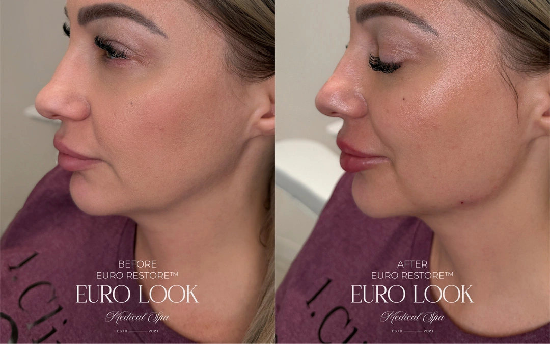 Dermal Fillers 39