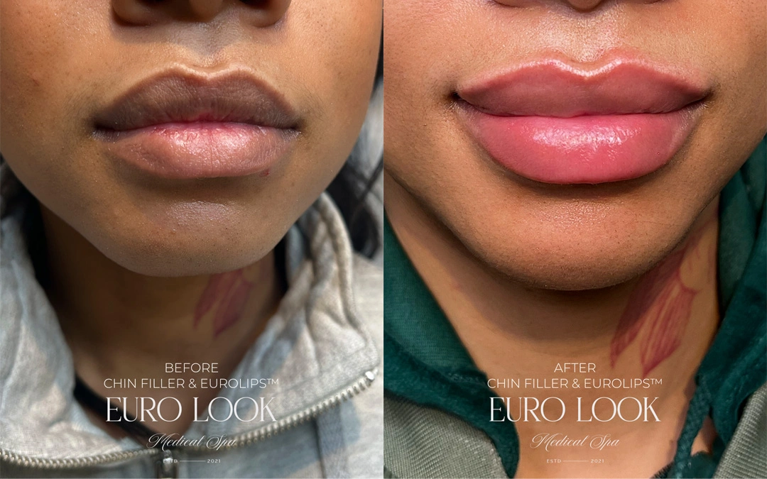 Dermal Fillers 4