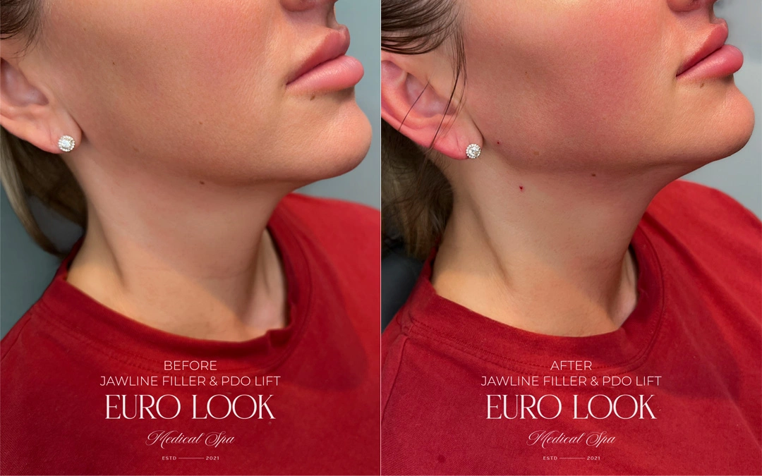 Dermal Fillers 40