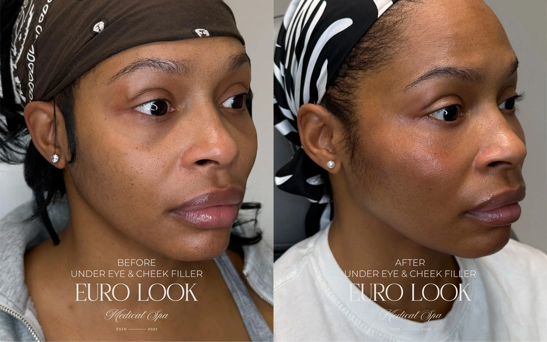 Dermal Fillers 41