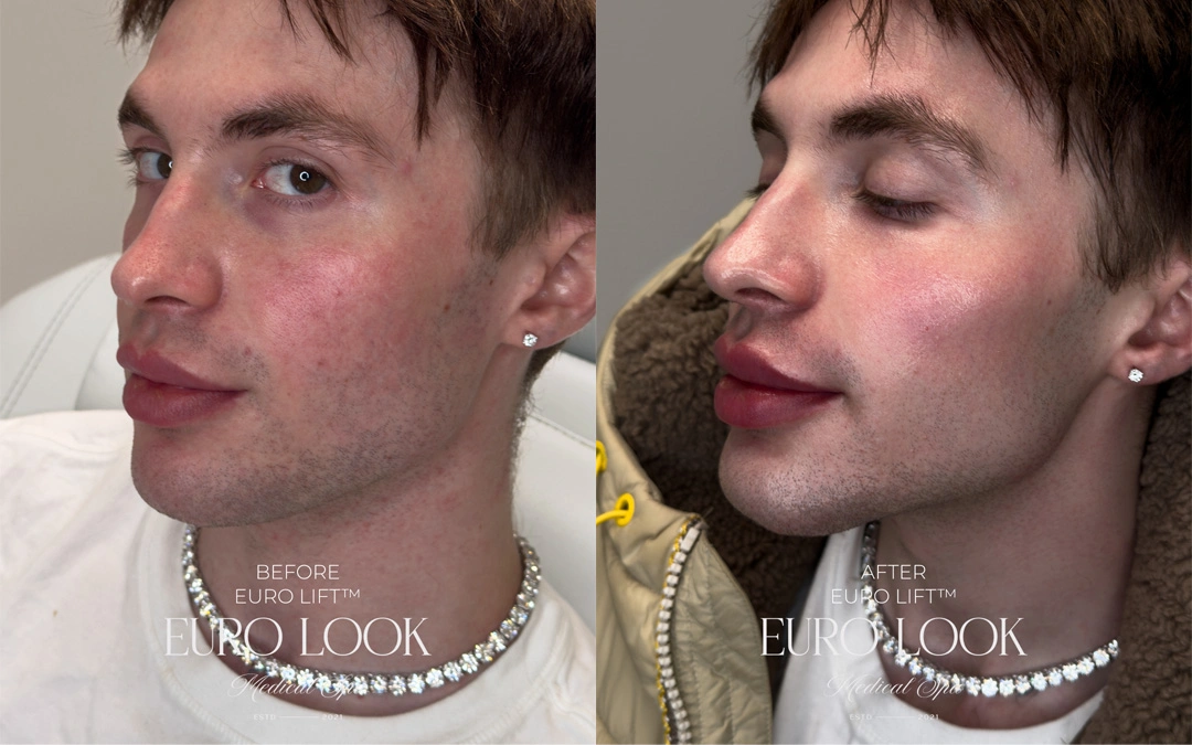 Dermal Fillers 42
