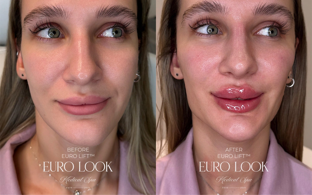 Dermal Fillers 43