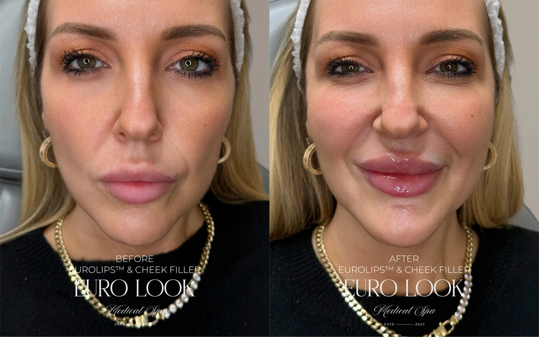 Dermal Fillers 44-2