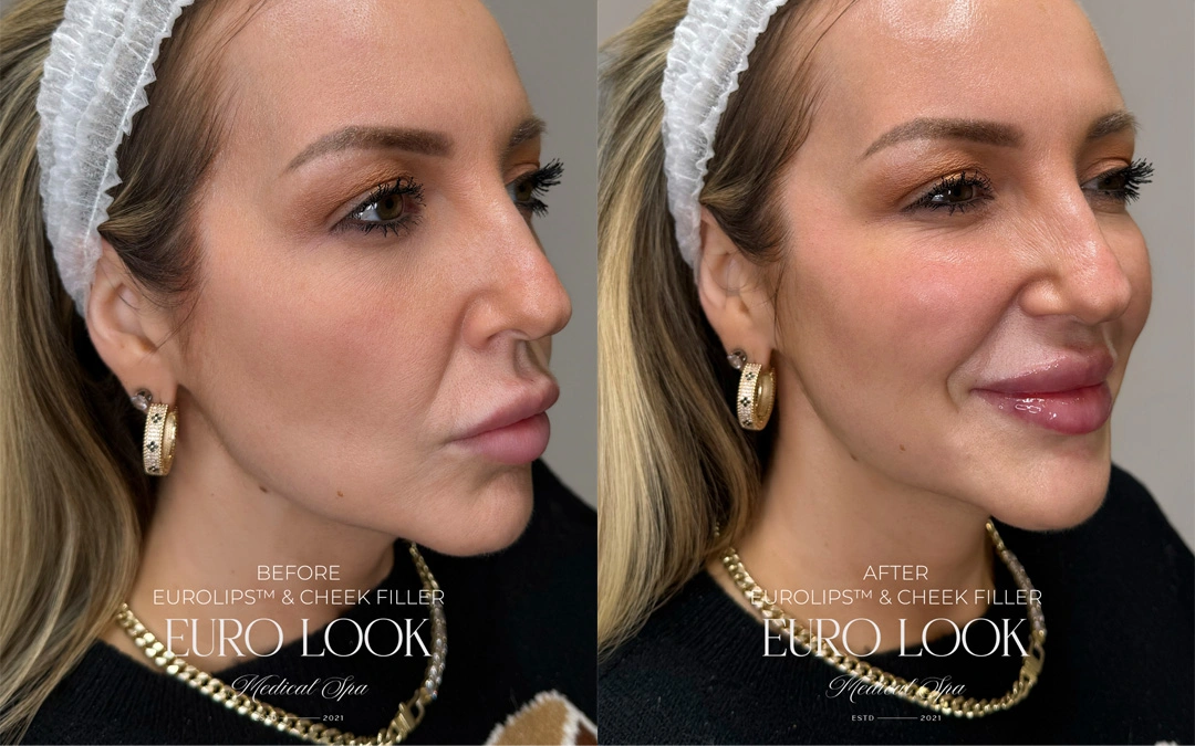 Dermal Fillers 44