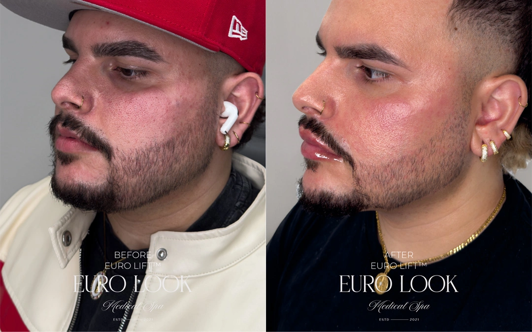 Dermal Fillers 45