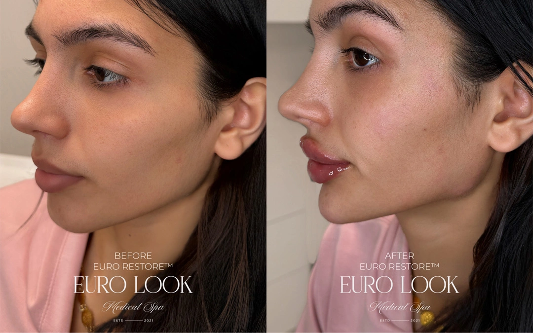 Dermal Fillers 46