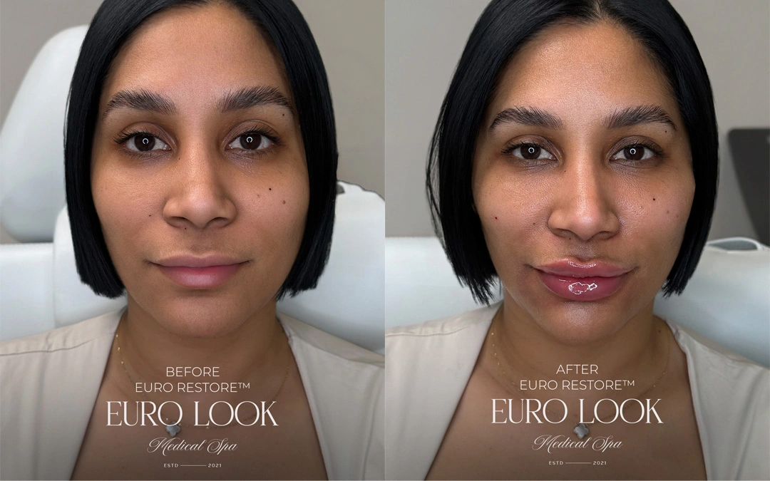Dermal Fillers 47