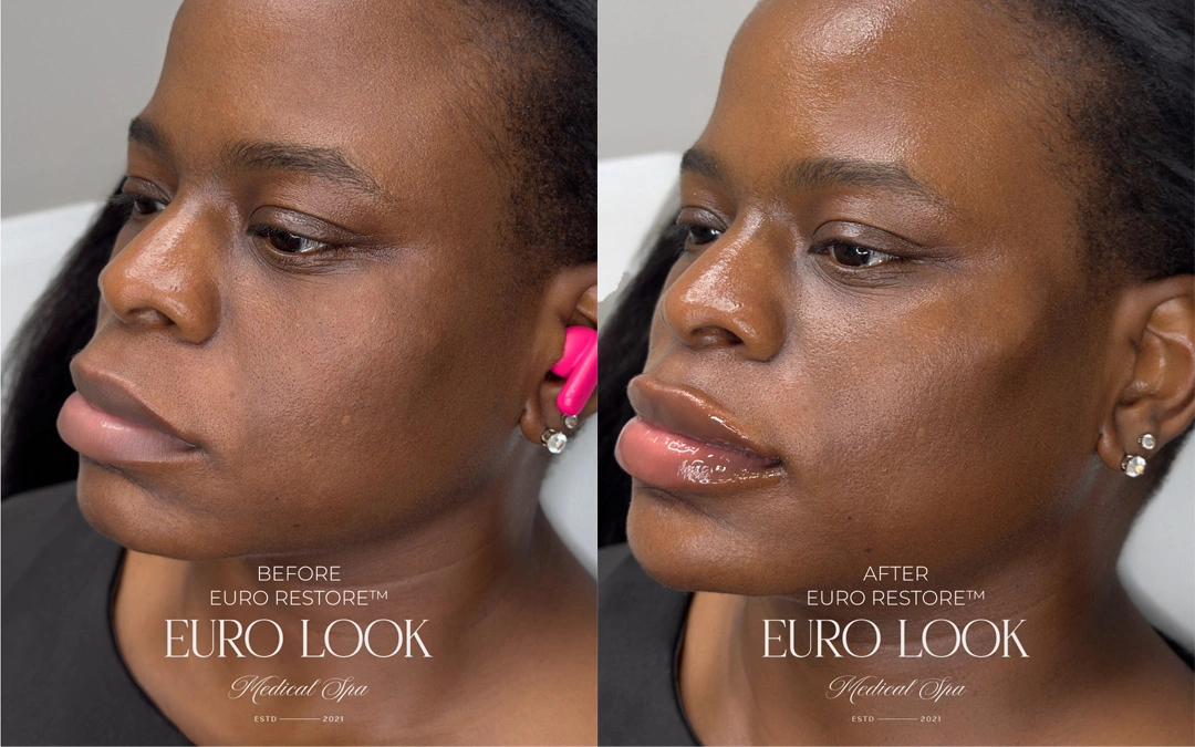 Dermal Fillers 48