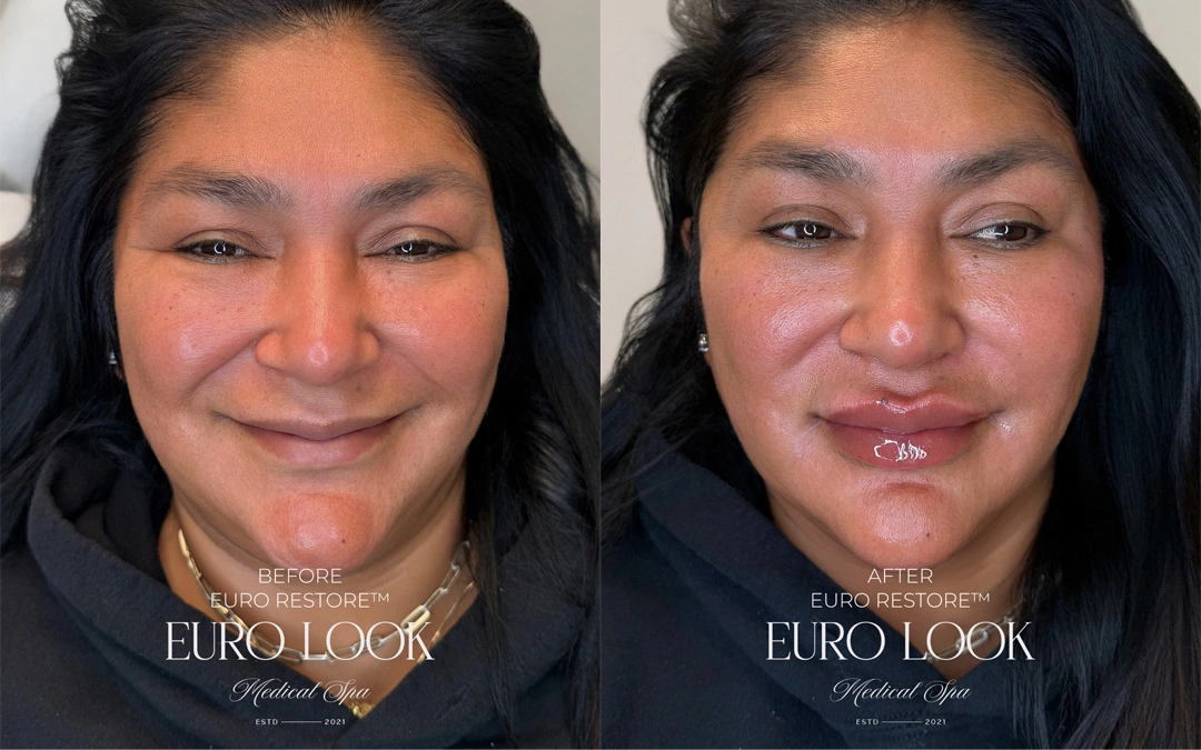 Dermal Fillers 49
