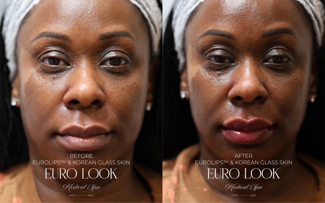 Dermal Fillers 5