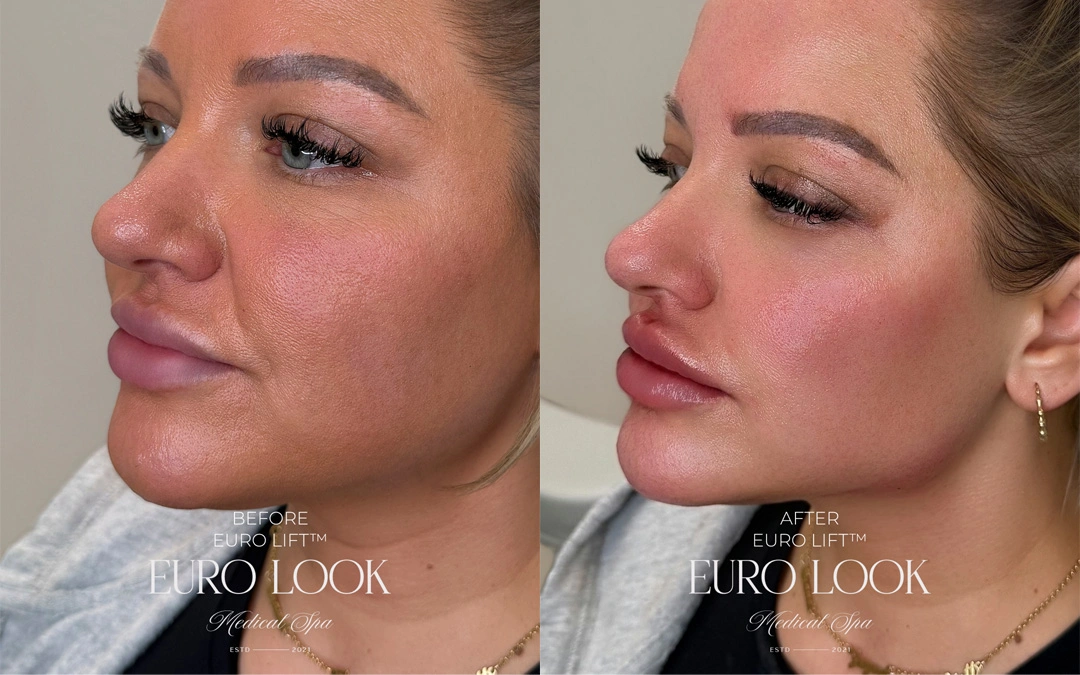 Dermal Fillers 50