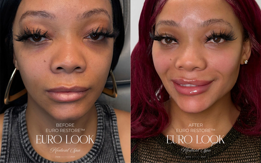 Dermal Fillers 51