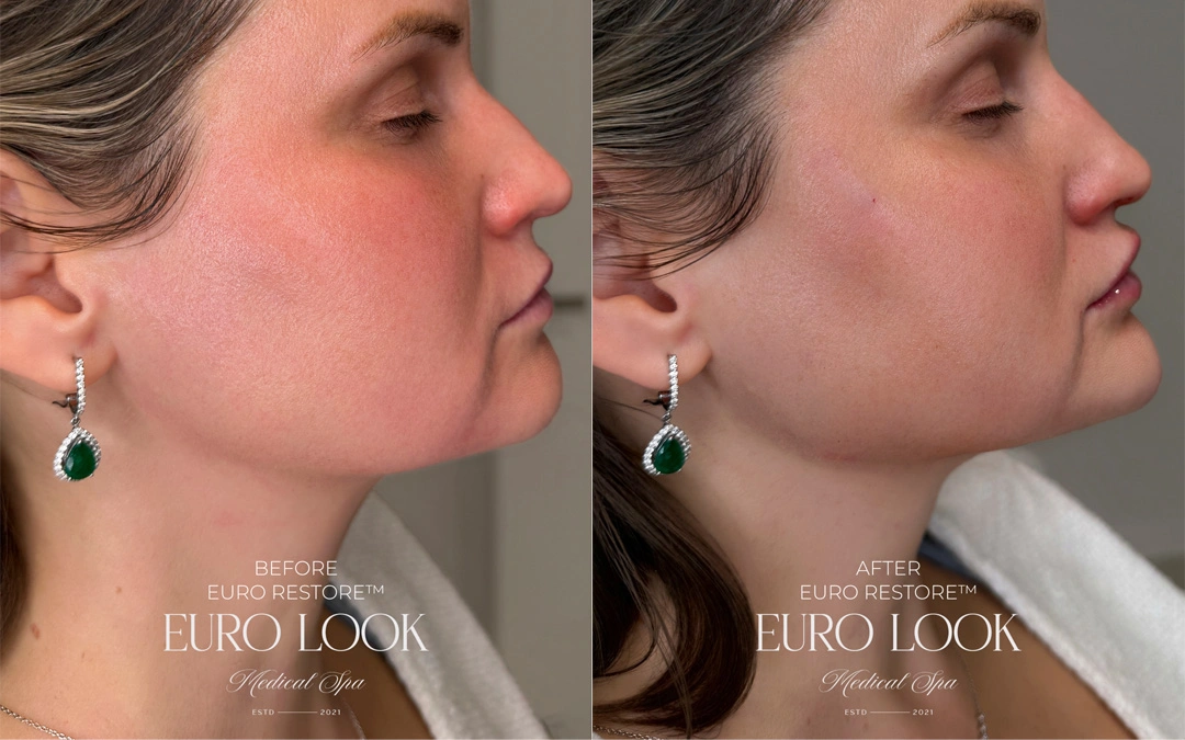 Dermal Fillers 52