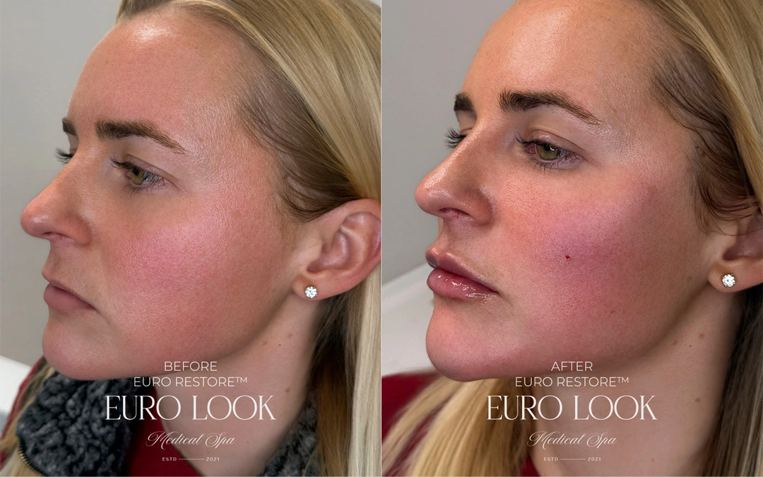 Dermal Fillers 53