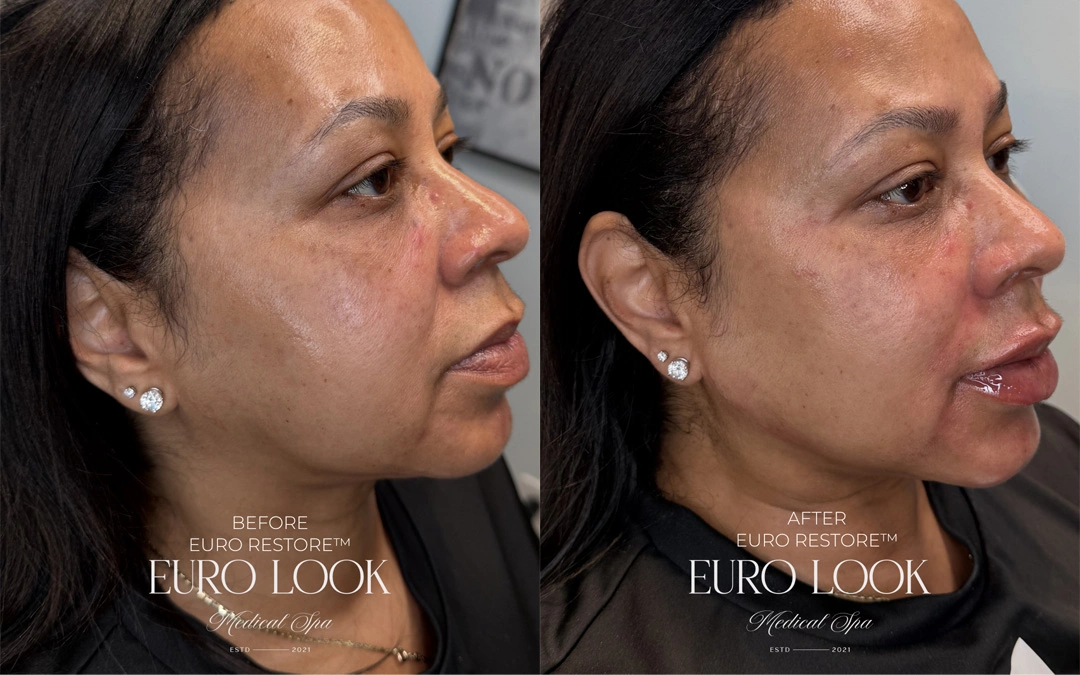 Dermal Fillers 54