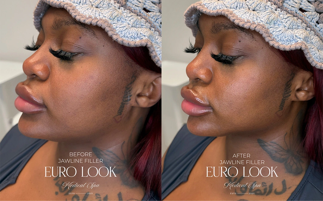 Dermal Fillers 55