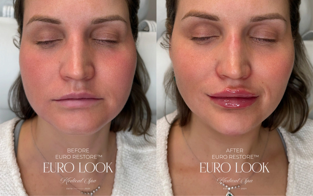 Dermal Fillers 6