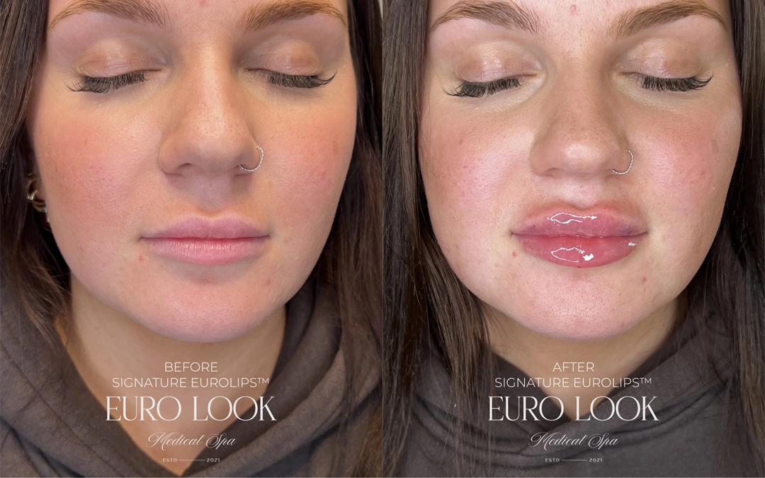 Dermal Fillers 7