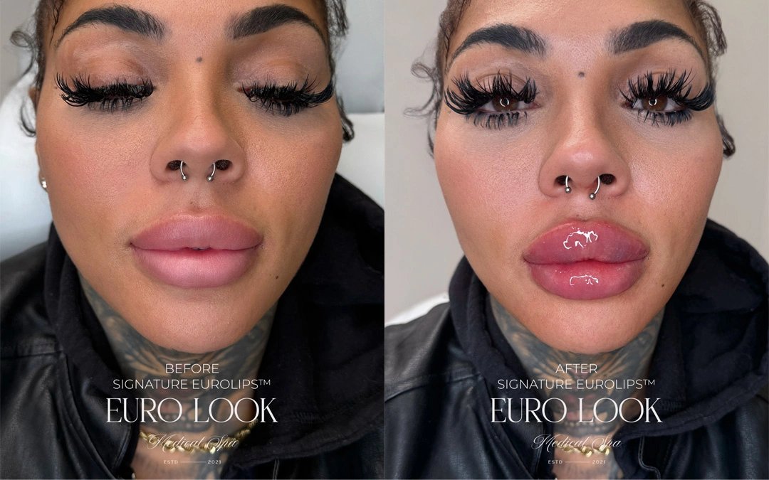 Dermal Fillers 8