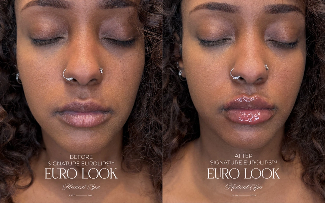 Dermal Fillers 9