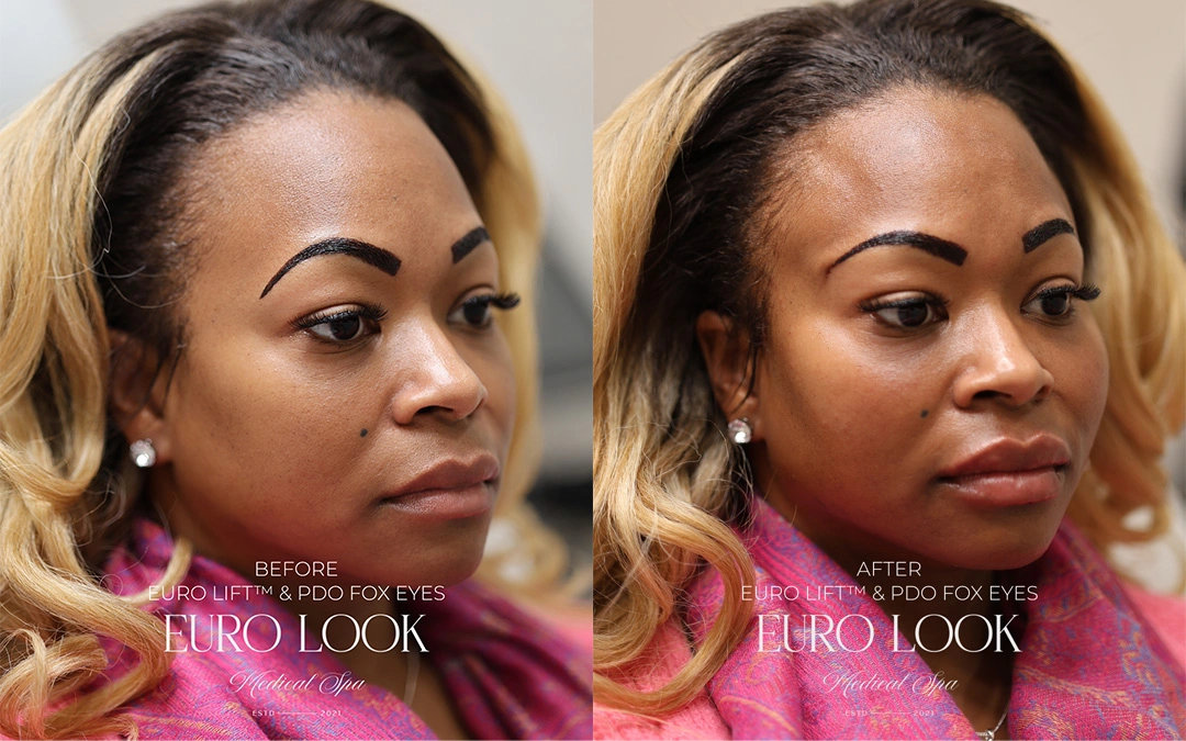 Dermal Fillers