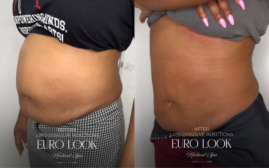 LIPO 1 – 270.png