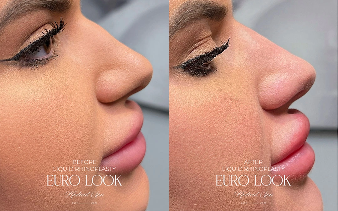 RHINOPLASTY 1 – 339