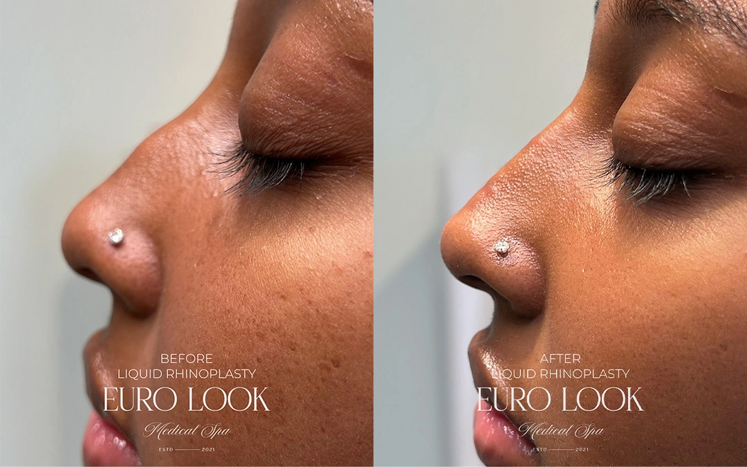 RHINOPLASTY 2 – 337