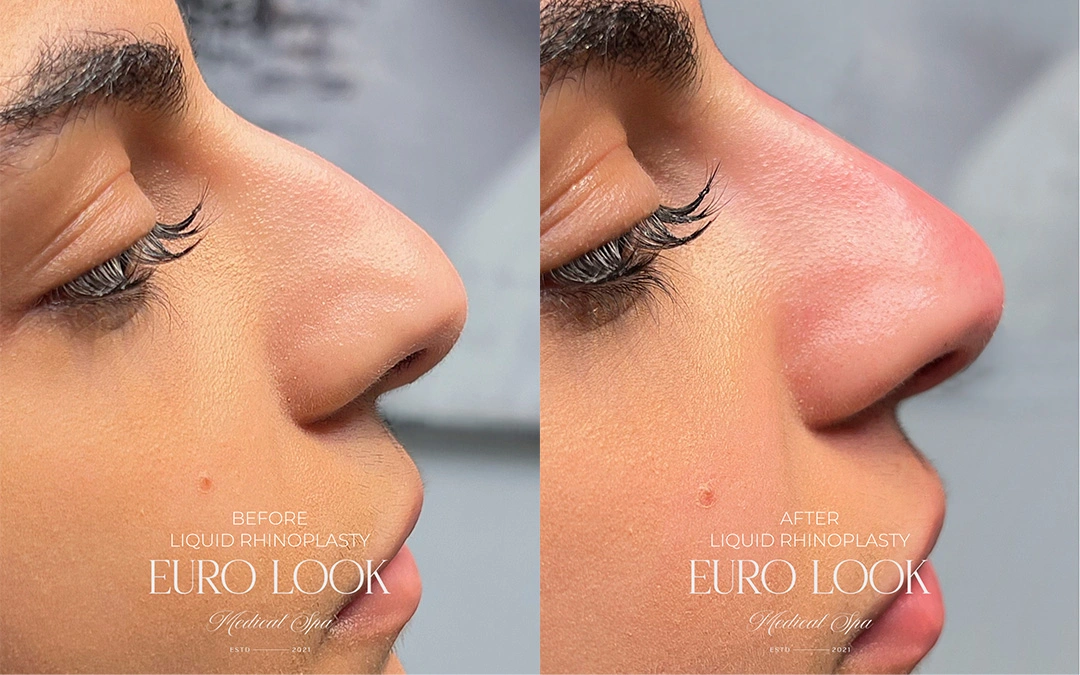 RHINOPLASTY 3 – 335