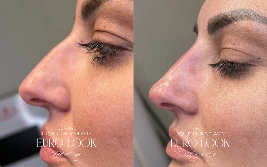 RHINOPLASTY 4 – 283