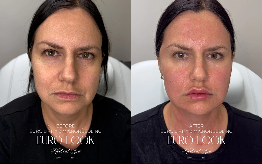 euro lift and microneedling 1-1