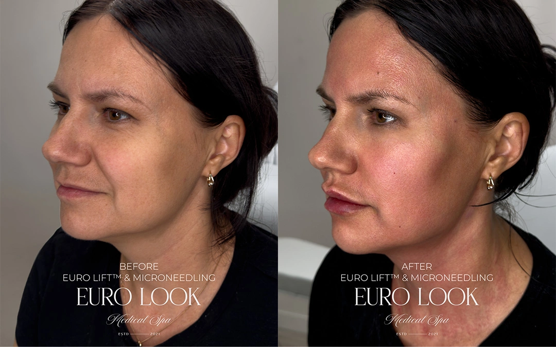 euro lift and microneedling 1-2