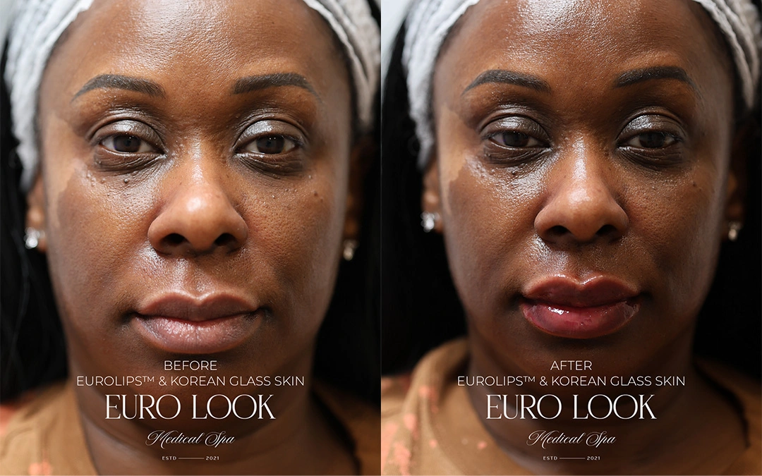 euro lips and glass skin 1